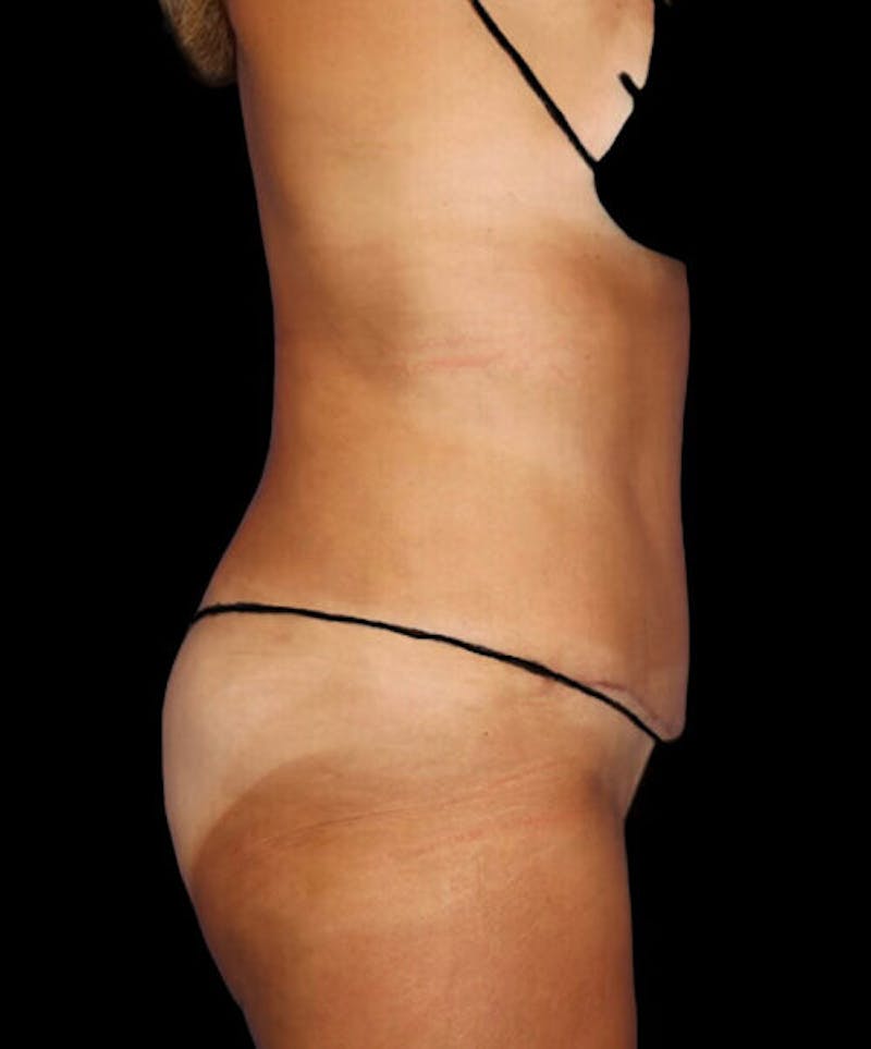 Abdominoplasty (Tummy Tuck) Before & After Gallery - Patient 294791 - Image 6
