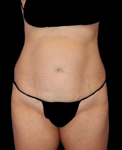 Abdominoplasty (Tummy Tuck) Before & After Gallery - Patient 130013 - Image 1
