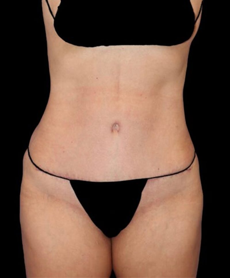 Abdominoplasty (Tummy Tuck) Before & After Gallery - Patient 130013 - Image 2