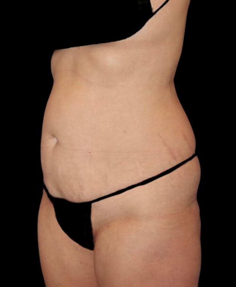 Abdominoplasty (Tummy Tuck) Before & After Gallery - Patient 130013 - Image 3