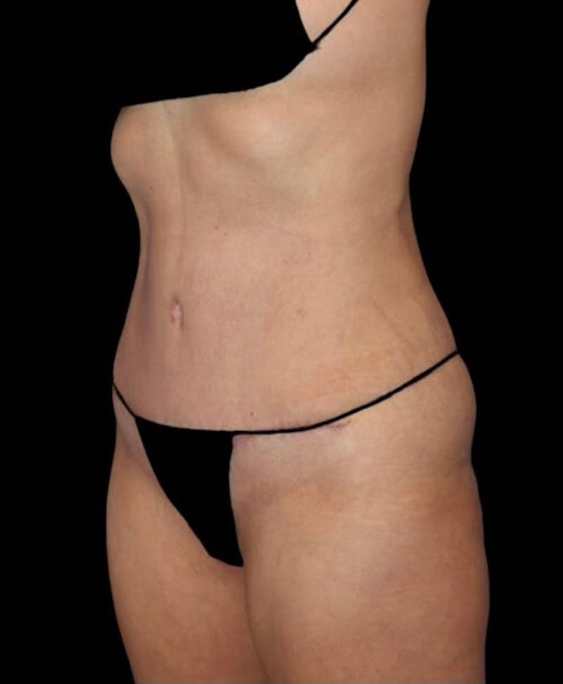 Abdominoplasty (Tummy Tuck) Before & After Gallery - Patient 130013 - Image 4