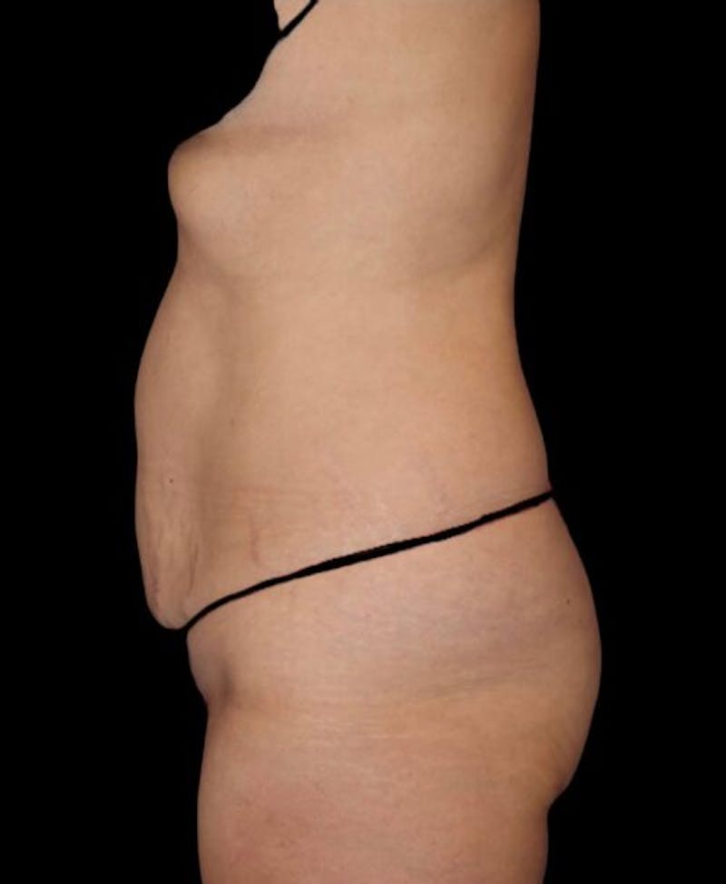 Abdominoplasty (Tummy Tuck) Before & After Gallery - Patient 130013 - Image 5
