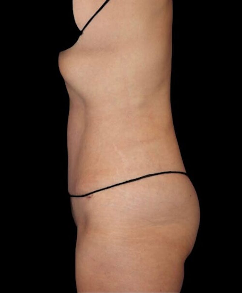 Abdominoplasty (Tummy Tuck) Before & After Gallery - Patient 130013 - Image 6