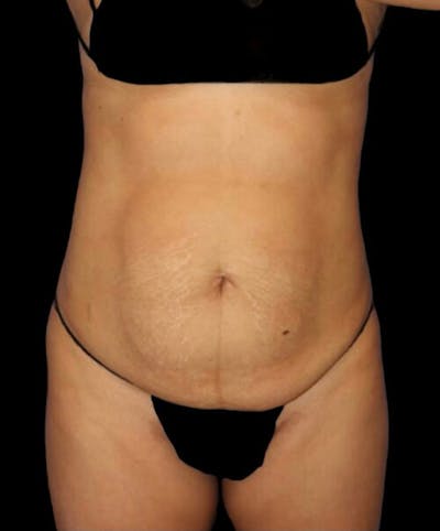 Abdominoplasty (Tummy Tuck) Before & After Gallery - Patient 416143 - Image 1