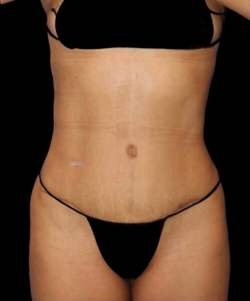 Abdominoplasty (Tummy Tuck) Before & After Gallery - Patient 416143 - Image 2