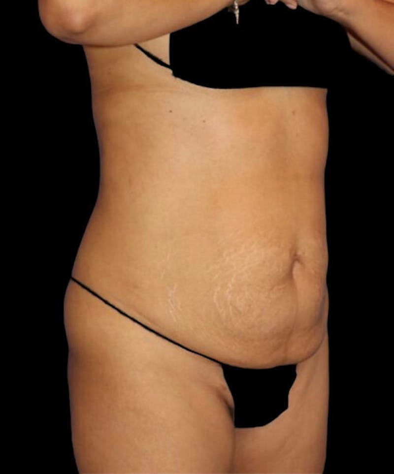 Abdominoplasty (Tummy Tuck) Before & After Gallery - Patient 416143 - Image 3