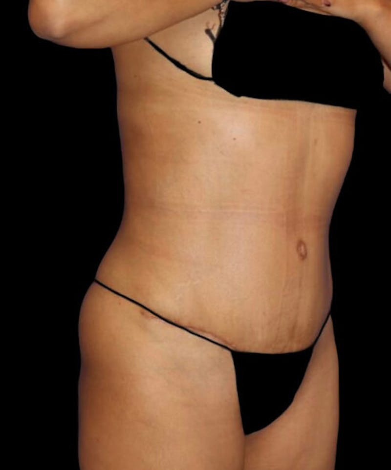 Abdominoplasty (Tummy Tuck) Before & After Gallery - Patient 416143 - Image 4