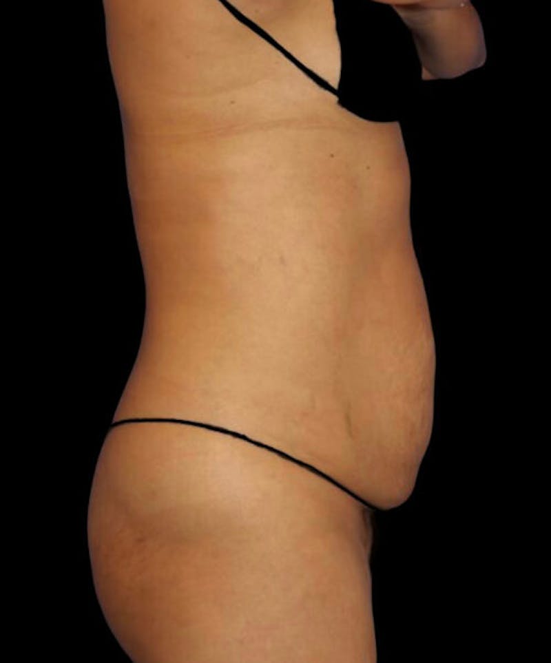 Abdominoplasty (Tummy Tuck) Before & After Gallery - Patient 416143 - Image 5