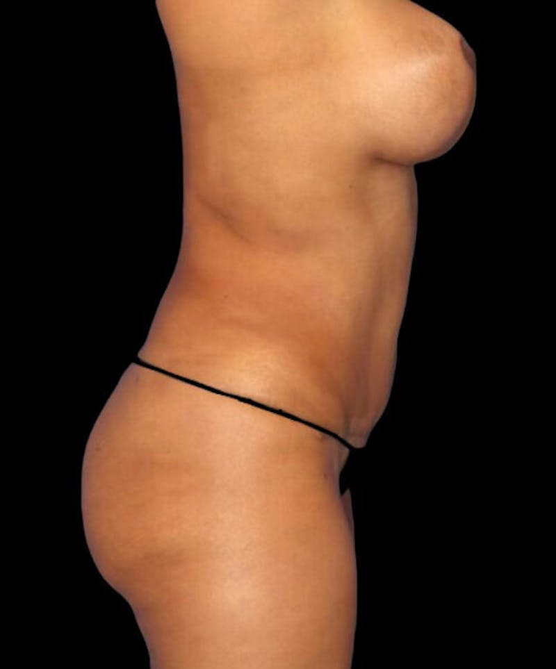 Mommy Makeover Before & After Gallery - Patient 321730 - Image 6