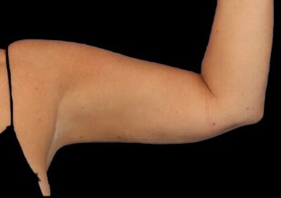 Arm Liposuction Before & After Gallery - Patient 273811 - Image 1