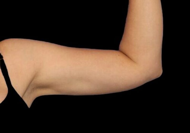 Arm Liposuction Before & After Gallery - Patient 273811 - Image 2
