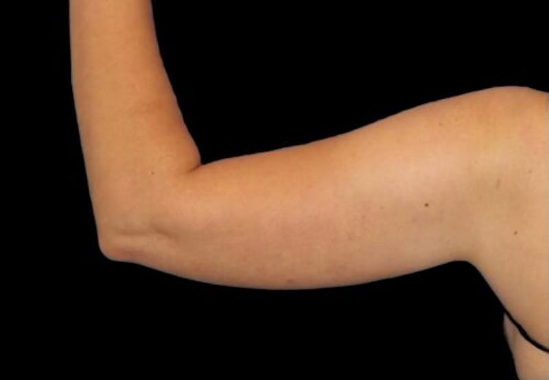 Arm Liposuction Before & After Gallery - Patient 273811 - Image 3