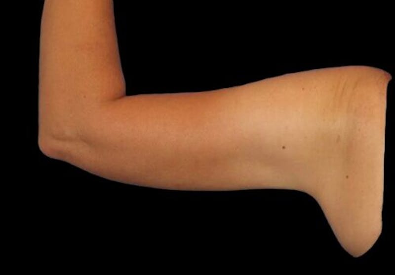 Arm Liposuction Before & After Gallery - Patient 273811 - Image 4