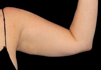 Arm Liposuction Before & After Gallery - Patient 130161 - Image 1