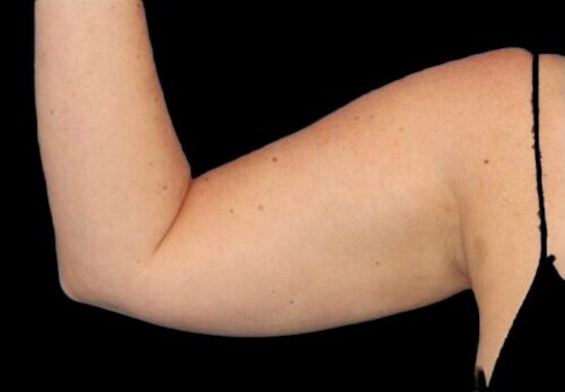 Arm Liposuction Before & After Gallery - Patient 130161 - Image 3