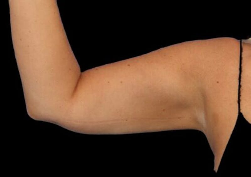 Arm Liposuction Before & After Gallery - Patient 130161 - Image 4