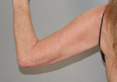 Arm Liposuction Before & After Gallery - Patient 306660 - Image 1