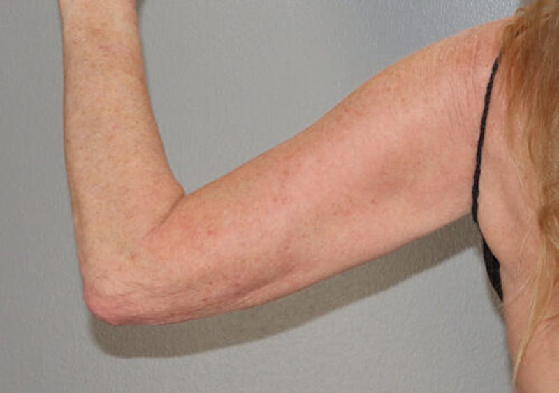 Arm Liposuction Before & After Gallery - Patient 306660 - Image 1