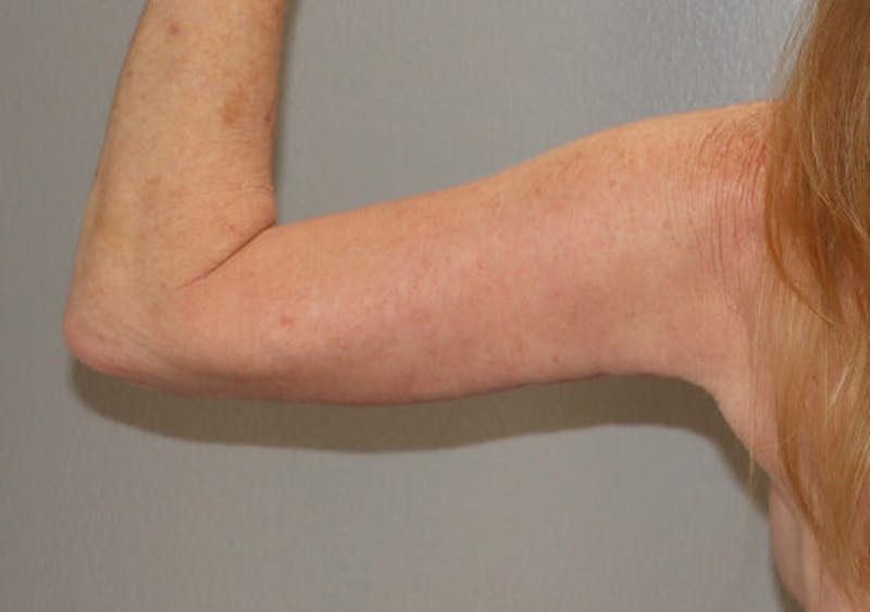 Arm Liposuction Before & After Gallery - Patient 306660 - Image 2