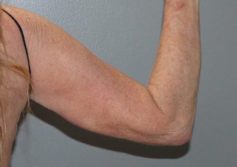 Arm Liposuction Before & After Gallery - Patient 306660 - Image 3
