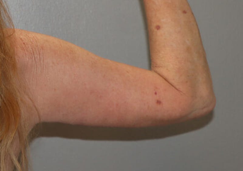 Arm Liposuction Before & After Gallery - Patient 306660 - Image 4