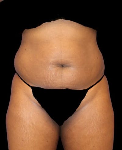 Liposuction Before & After Gallery - Patient 389671 - Image 1
