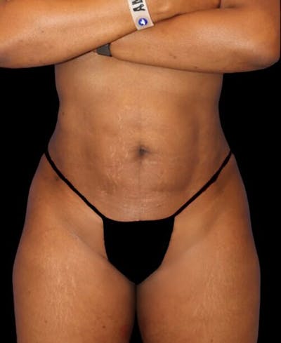 Liposuction Before & After Gallery - Patient 389671 - Image 2