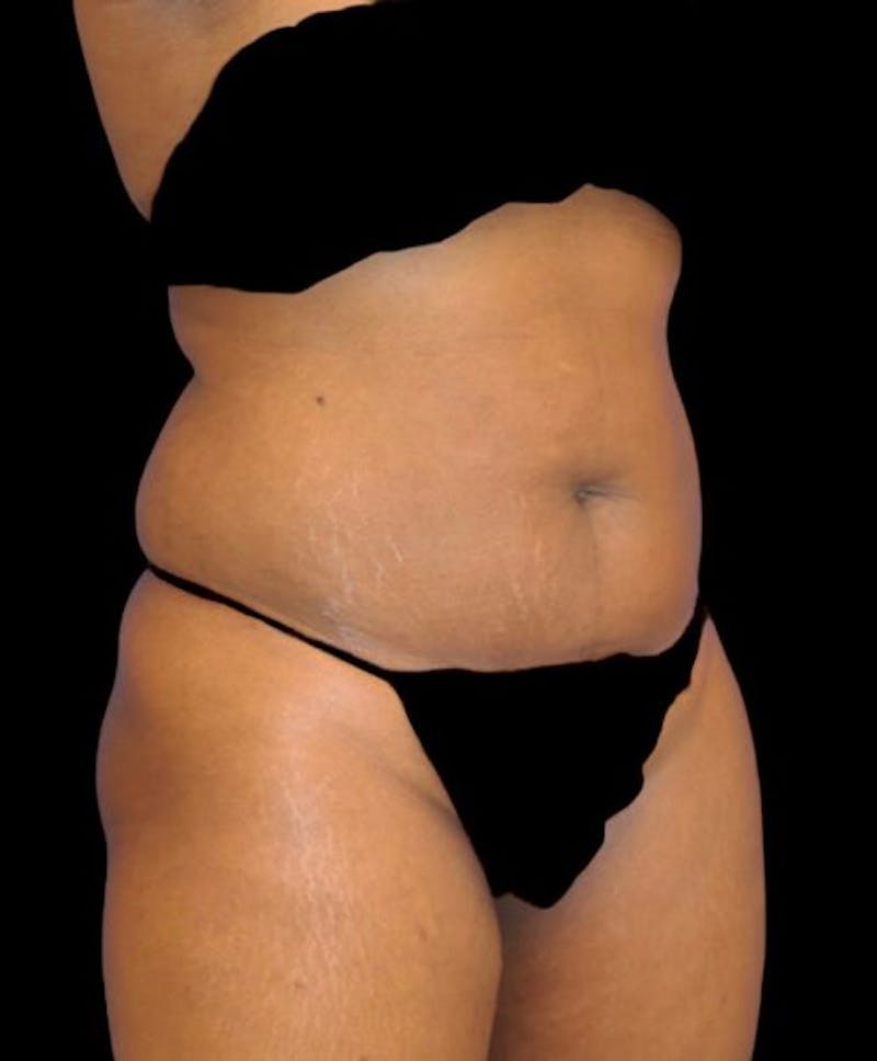Liposuction Before & After Gallery - Patient 389671 - Image 3