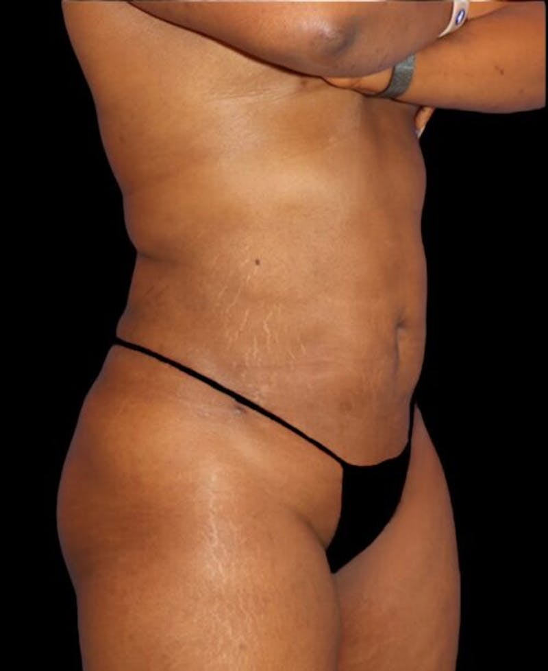 Liposuction Before & After Gallery - Patient 389671 - Image 4