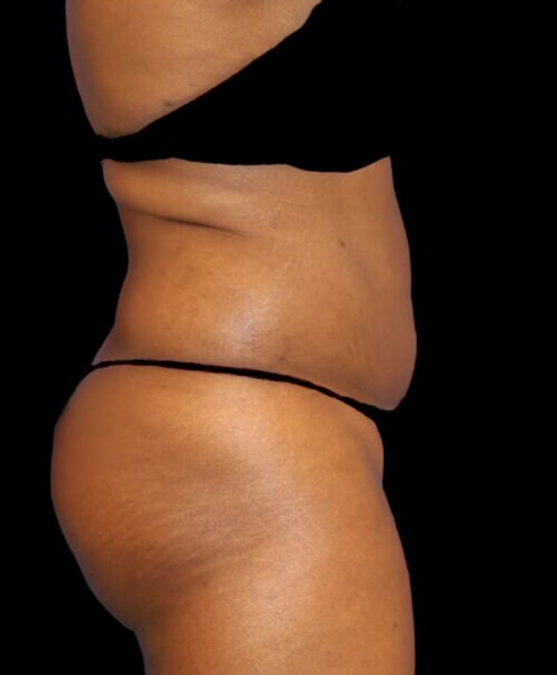 Liposuction Before & After Gallery - Patient 389671 - Image 5
