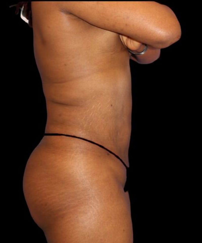 Liposuction Before & After Gallery - Patient 389671 - Image 6