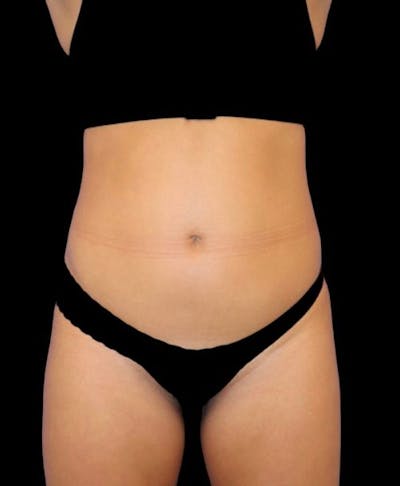 Liposuction Before & After Gallery - Patient 992436 - Image 1