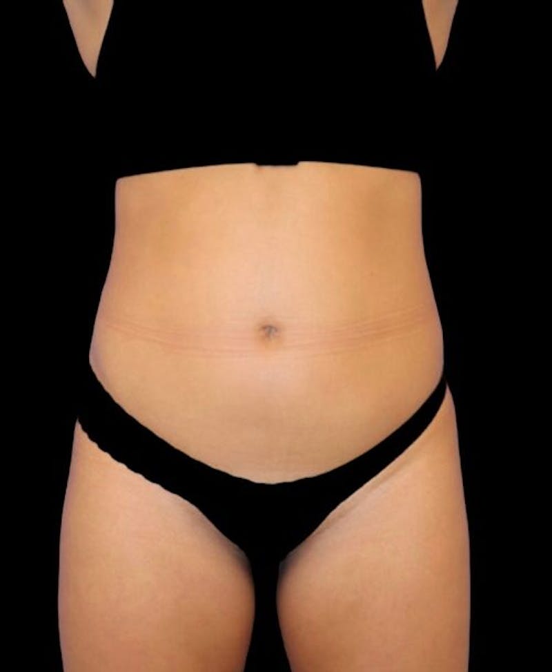 Liposuction Before & After Gallery - Patient 992436 - Image 1