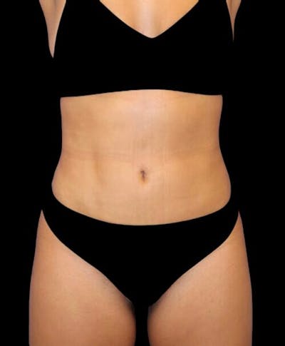 Liposuction Before & After Gallery - Patient 992436 - Image 2