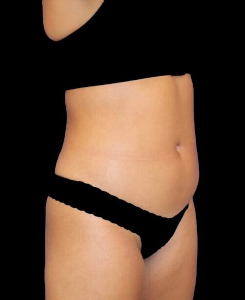 Liposuction Before & After Gallery - Patient 992436 - Image 3