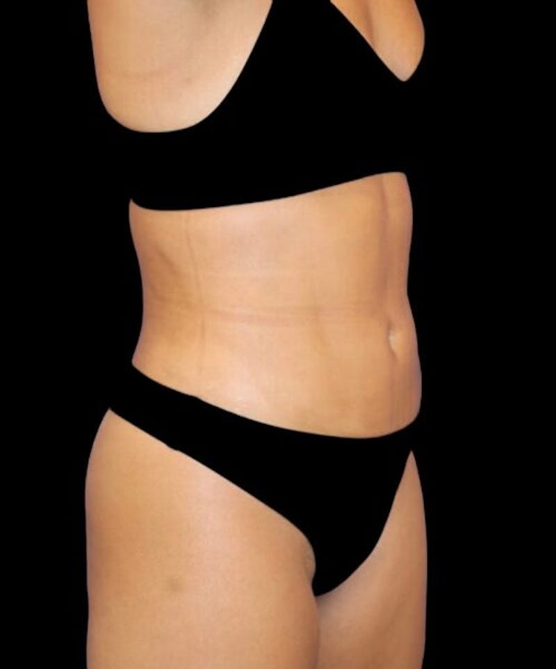 Liposuction Before & After Gallery - Patient 992436 - Image 4