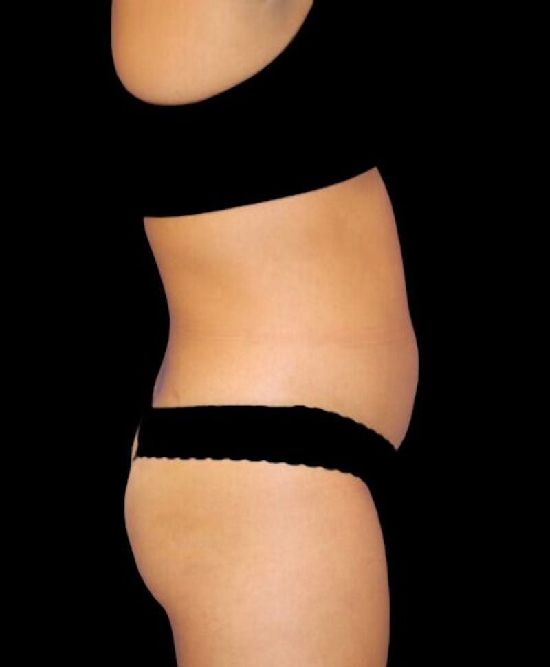 Liposuction Before & After Gallery - Patient 992436 - Image 5