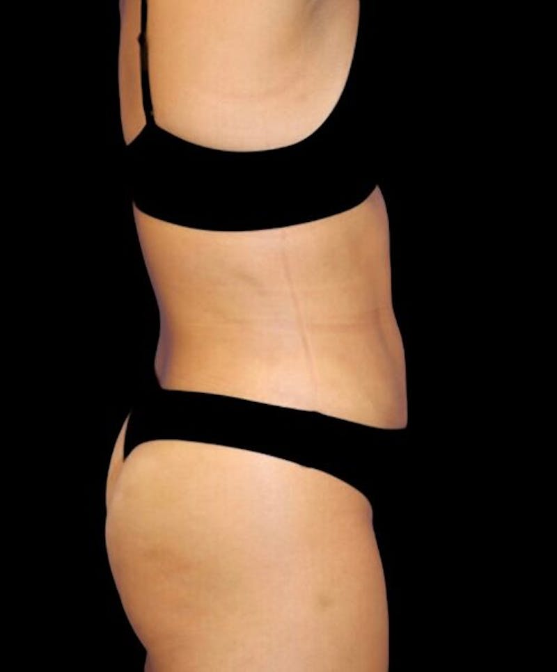 Liposuction Before & After Gallery - Patient 992436 - Image 6