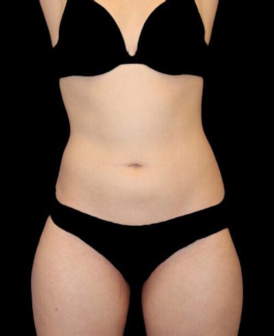 Liposuction Before & After Gallery - Patient 338144 - Image 1