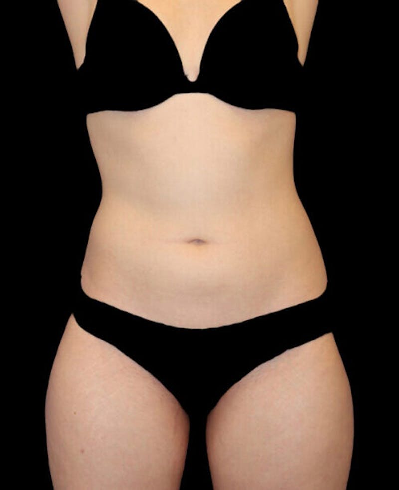 Liposuction Before & After Gallery - Patient 338144 - Image 1