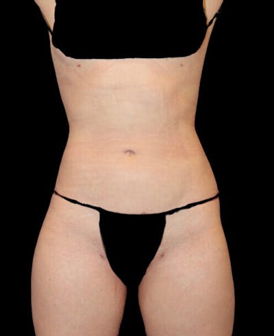 Liposuction Before & After Gallery - Patient 338144 - Image 2