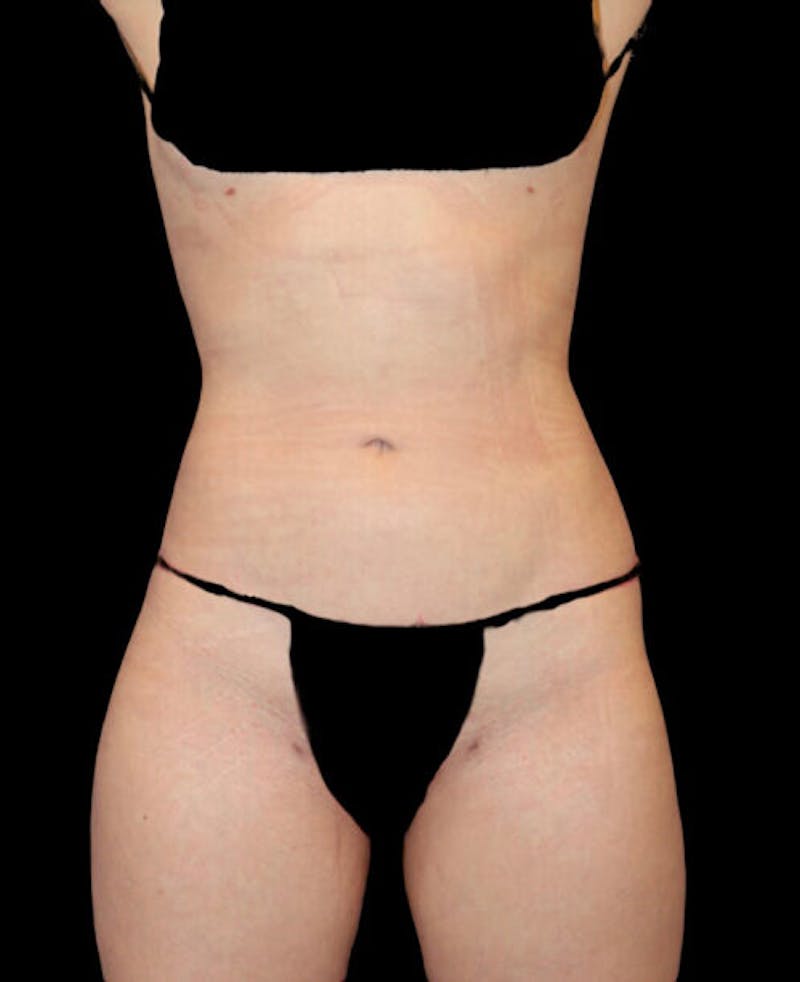 Liposuction Before & After Gallery - Patient 338144 - Image 2