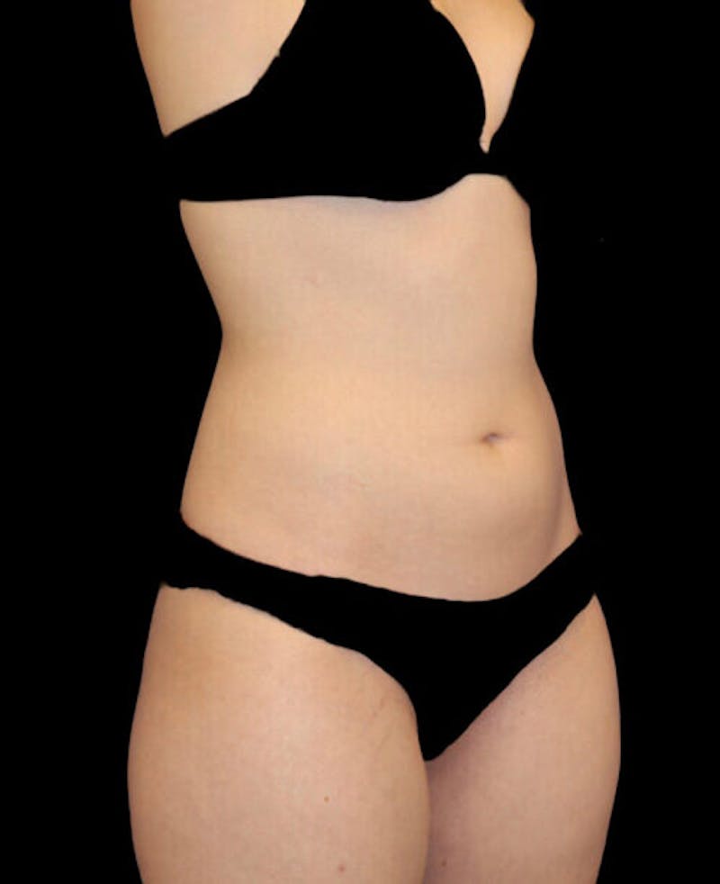 Liposuction Before & After Gallery - Patient 338144 - Image 3