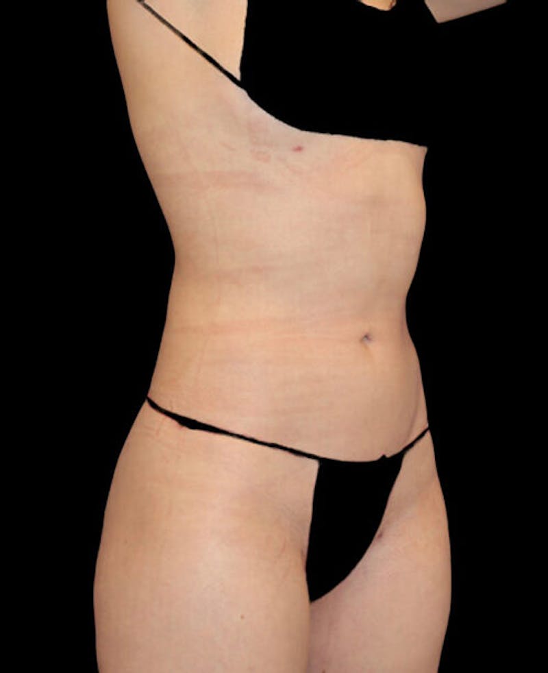 Liposuction Before & After Gallery - Patient 338144 - Image 4