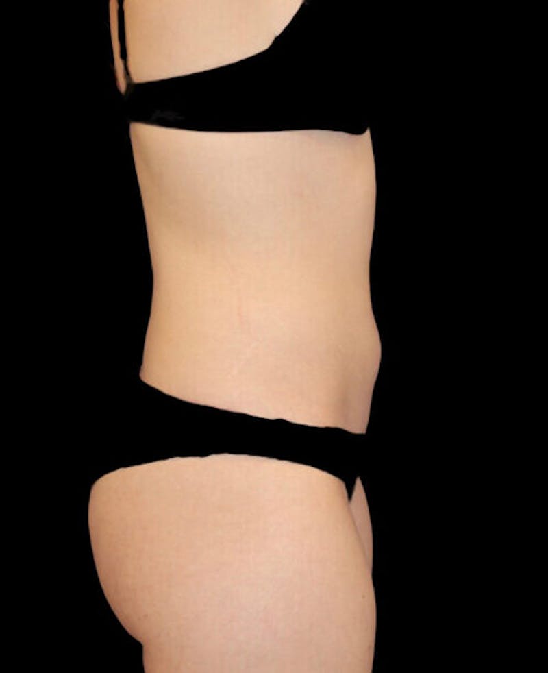 Liposuction Before & After Gallery - Patient 338144 - Image 5