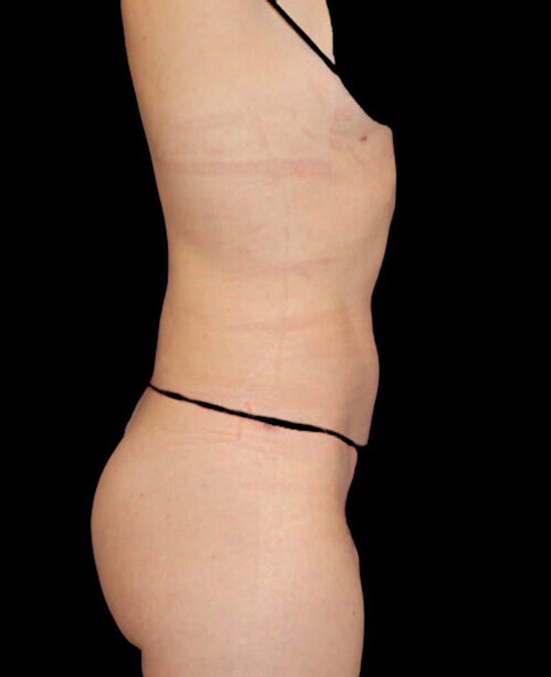 Liposuction Before & After Gallery - Patient 338144 - Image 6