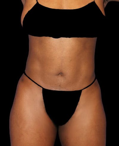 Liposuction Before & After Gallery - Patient 977687 - Image 2