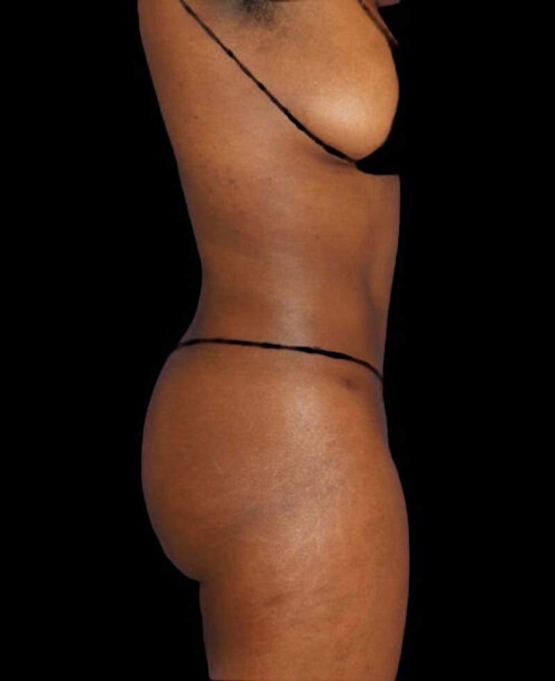Liposuction Before & After Gallery - Patient 409752 - Image 6