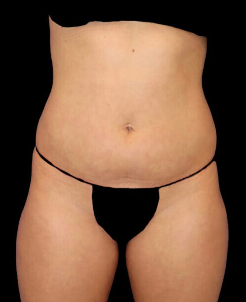 Liposuction Before & After Gallery - Patient 209778 - Image 1
