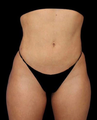 Liposuction Before & After Gallery - Patient 209778 - Image 2